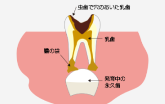 乳歯が虫歯になるとについての説明画像