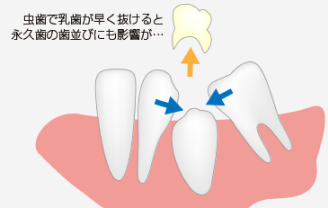 虫歯によって乳歯がなくなるとの説明画像