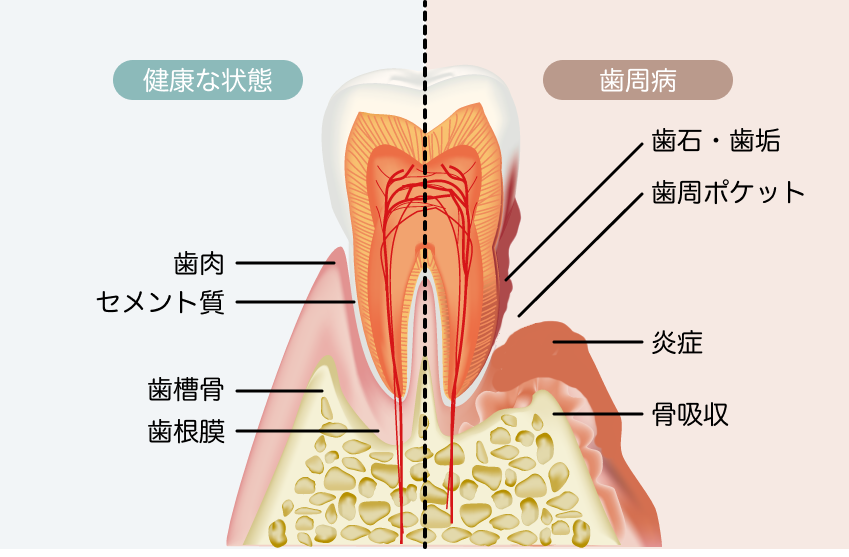 歯周病の説明図