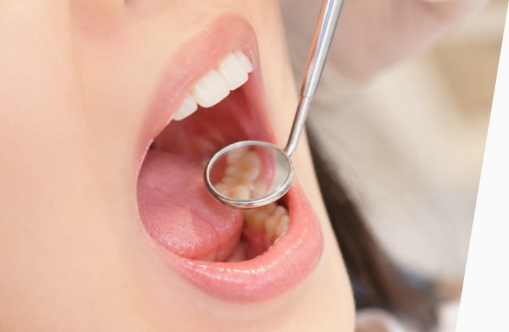 歯科医師がミラーでお口の中を確認している様子