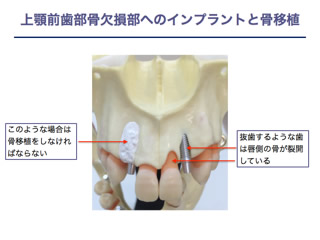 骨誘導再生法 練馬区江古田のおざわ歯科インプラントクリニック