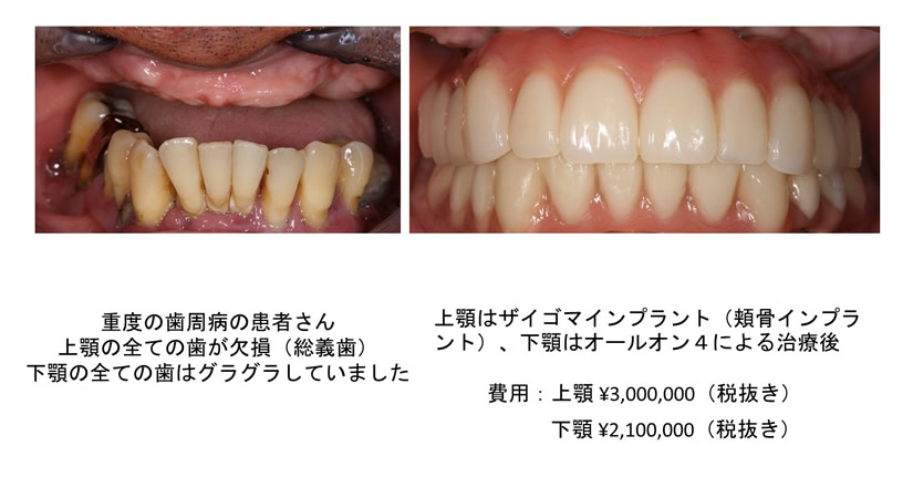 ザイゴマインプラント 練馬区江古田のおざわ歯科インプラントクリニック